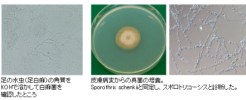 水虫の角質/真菌の培養 写真