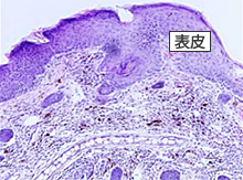 炎症を起こした皮膚(マウス)